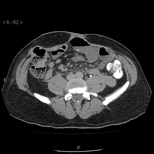 Colo-cutaneous fistula (Radiopaedia 40531-43129 A 21).jpg