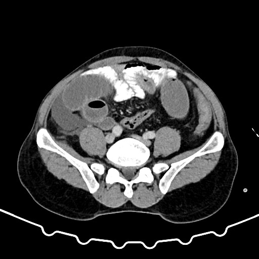 File:Colocolic intussusception due to large lipoma (Radiopaedia 68773-78482 A 131).jpg