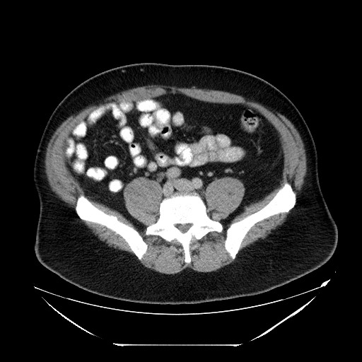 Colocolic intussusception due to lipoma (Radiopaedia 73712-84508 A 79).jpg