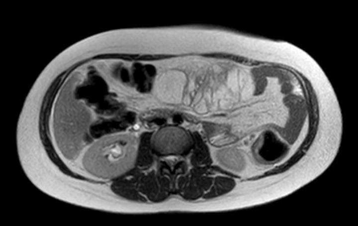 Colon adenocarcinoma with Krukenberg tumors, advanced pregnancy (Radiopaedia 67279-76645 Axial T2 47).jpg