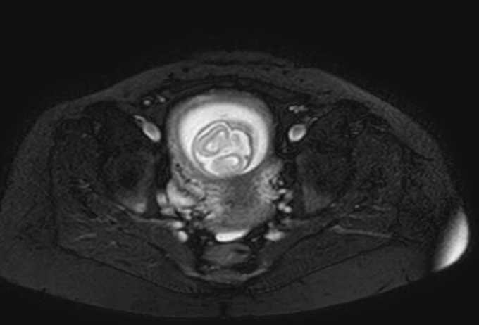 Colon adenocarcinoma with Krukenberg tumors, advanced pregnancy (Radiopaedia 67279-76645 Axial T2 SPAIR 11).jpg