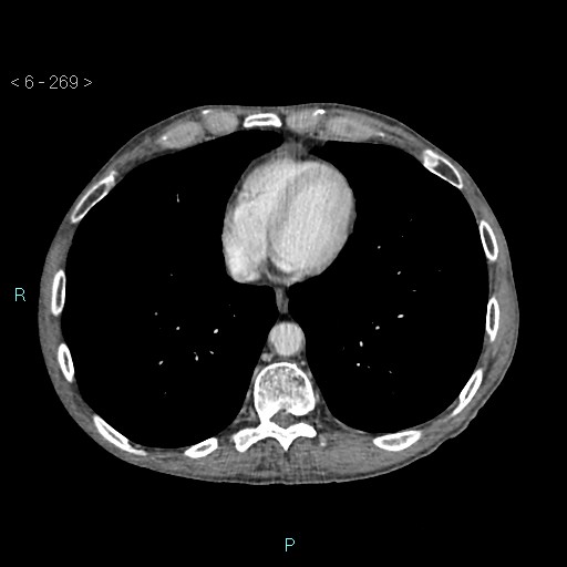 Colonic cancer (ultrasound and TC imaging) (Radiopaedia 50346-55713 B 269).jpg