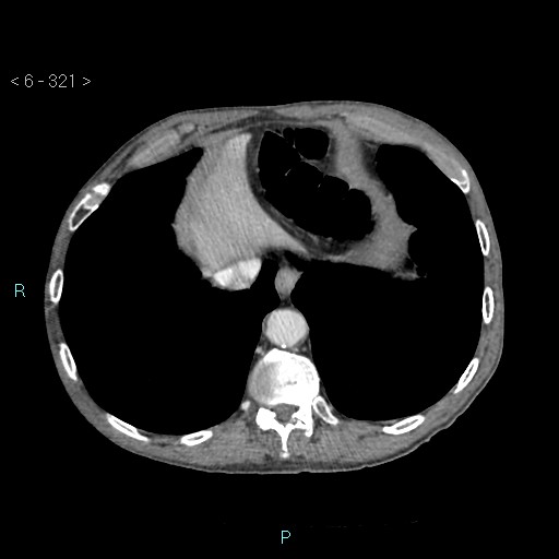 File:Colonic cancer (ultrasound and TC imaging) (Radiopaedia 50346-55713 B 321).jpg