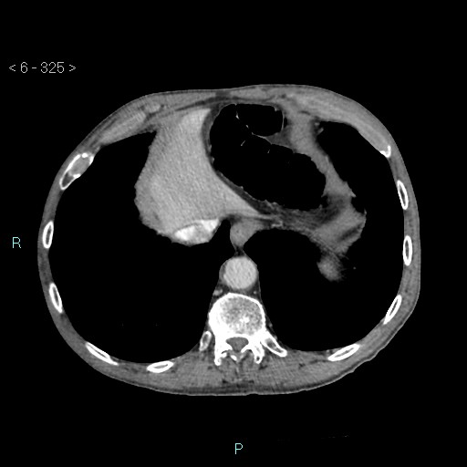 File:Colonic cancer (ultrasound and TC imaging) (Radiopaedia 50346-55713 B 325).jpg