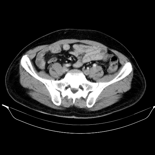 File:Colonic lipoma with colo-colic intussusception (Radiopaedia 58944-66200 Axial 16).jpg