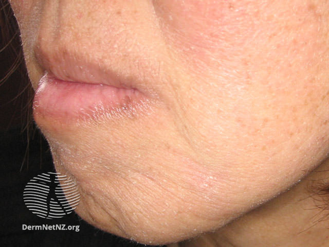 File:Facial eczema (DermNet NZ dermatitis-atopic40).jpg