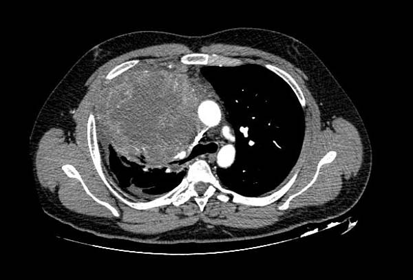 File:Germ cell tumor of the anterior mediastinum (Radiopaedia 12086).jpeg