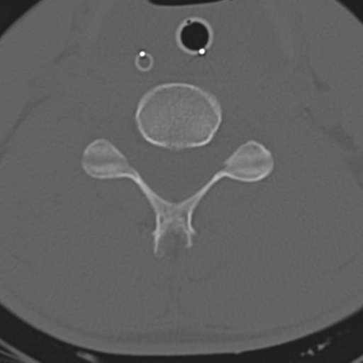 File:Multitrauma with diffuse axonal injury, temporal bone fractures and traumatic caroticocavernous fistula (Radiopaedia 37242-39035 Axial 170).png