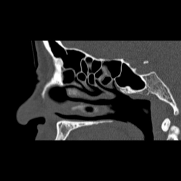 Nasal septal perforation (Radiopaedia 25030-25289 Sagittal bone window 39).jpg