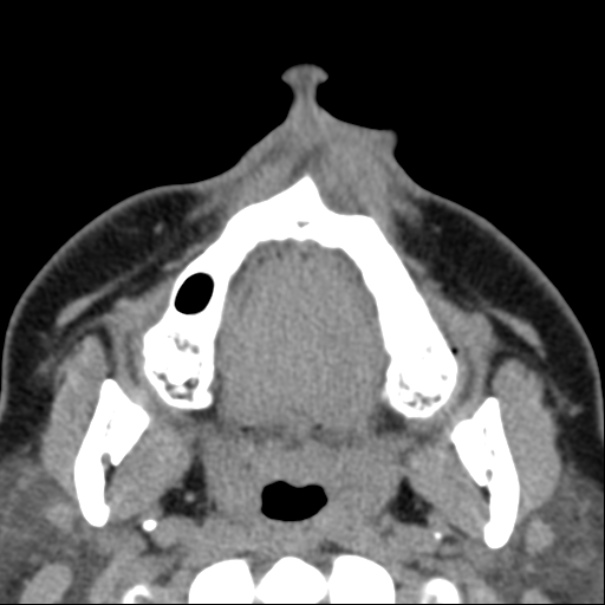 Nasolabial cyst (Radiopaedia 33987-35205 Axial non-contrast 4).jpg