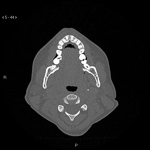 Nasolabial cyst (Radiopaedia 75125-86194 Axial bone window 5).jpg
