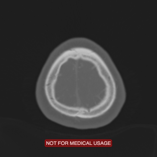 File:Nasopharyngeal carcinoma recurrence - skull base destruction (Radiopaedia 29107-29490 Axial bone window 11).jpg