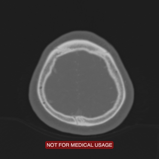 Nasopharyngeal carcinoma recurrence - skull base destruction (Radiopaedia 29107-29490 Axial bone window 16).jpg
