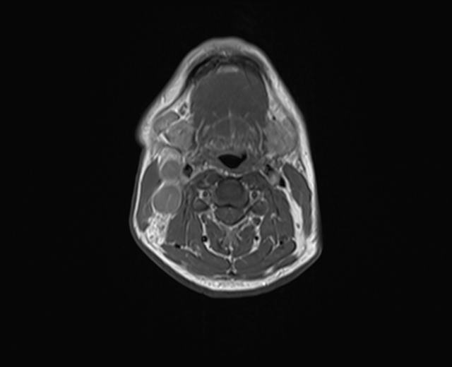 File:Nasopharyngeal carcinoma with perineural spread (Radiopaedia 55030-61380 Axial T1 15).jpg