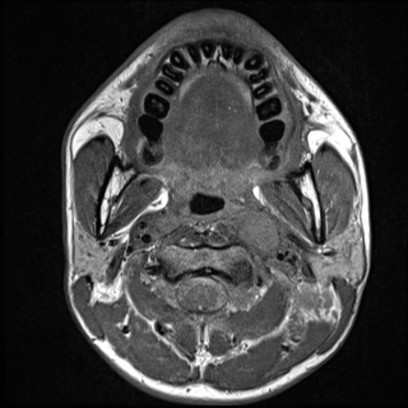 Nasopharyngeal carcinoma with skull base invasion (Radiopaedia 53415-59485 Axial T1 37).jpg