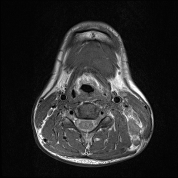Nasopharyngeal carcinoma with skull base invasion (Radiopaedia 53415-59485 Axial T1 53).jpg