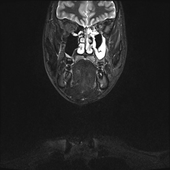 Nasopharyngeal carcinoma with skull base invasion (Radiopaedia 53415-59485 Coronal T2 fat sat 30).jpg