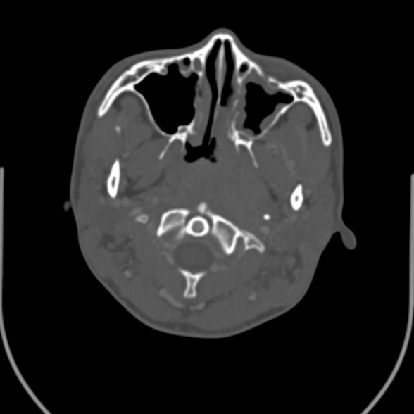 File:Nasopharyngeal carcinoma with skull base invasion (Radiopaedia 53415-59705 Axial bone window 52).jpg