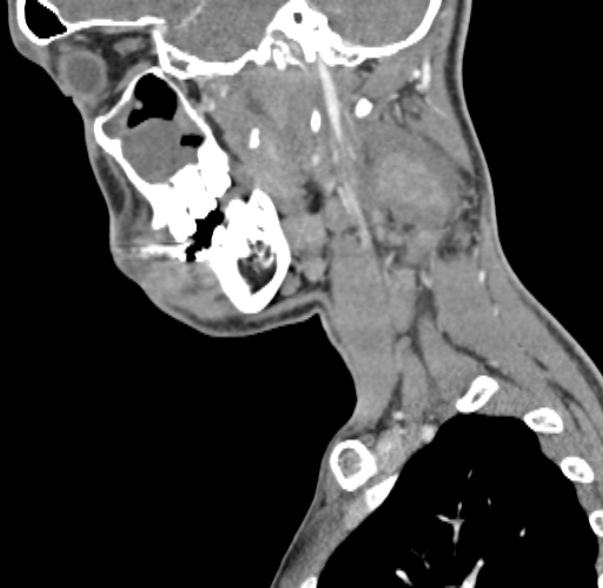 Nasopharyngeal carcinoma with skull base invasion (Radiopaedia 53415-59705 C 53).jpg