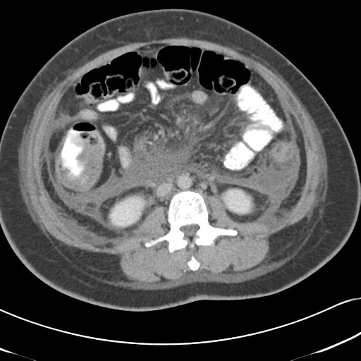 Necrotizing pancreatitis (Radiopaedia 50998-56540 A 42).png