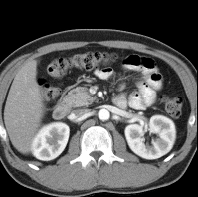 File:Necrotizing pancreatitis with acute necrotic collection (Radiopaedia 14470-14417 B 16).jpg