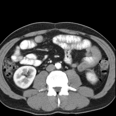 File:Necrotizing pancreatitis with acute necrotic collection (Radiopaedia 14470-14417 B 29).jpg