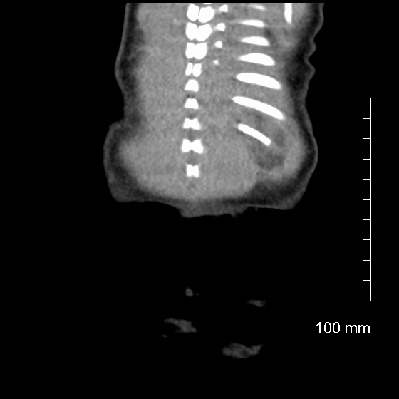 File:Neonatal neuroblastoma (Radiopaedia 56651-63438 Coronal non-contrast 46).jpg