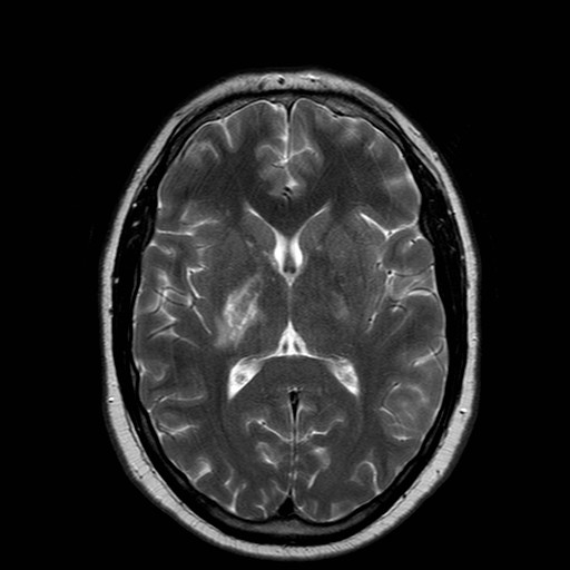 File:Neuro-Behcet's disease (Radiopaedia 21557-21505 Axial T2 12).jpg