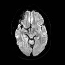File:Neuro-Behcet's disease (Radiopaedia 21557-21506 Axial DWI 12).jpg