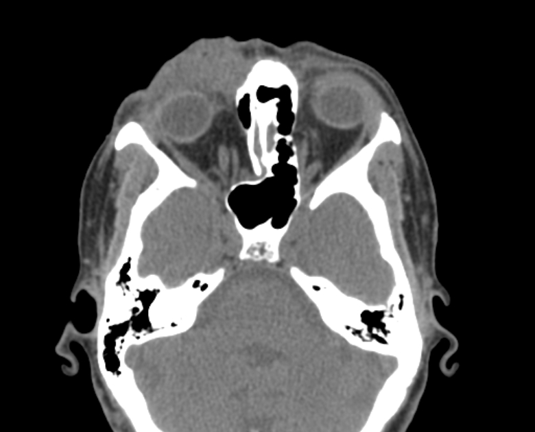 Neurofibromatosis type 1- orbital manifestations (Radiopaedia 49391-54511 Axial non-contrast 51).jpg