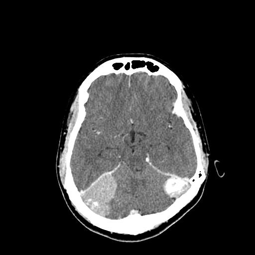 File:Neurofibromatosis type 2 (Radiopaedia 25389-25637 Axial C+ 30).jpg