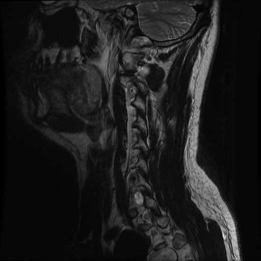 File:Neurofibromatosis type 2 (Radiopaedia 44936-48837 Sagittal T2 14).png