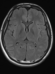 File:Neurofibromatosis type 2 (Radiopaedia 44936-48838 Axial FLAIR 13).png