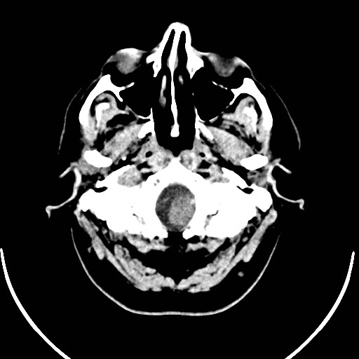 Neurofibromatosis type 2 (Radiopaedia 79097-92047 Axial non-contrast 5).jpg