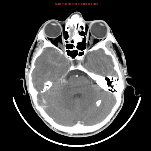 File:Neurofibromatosis type 2 (Radiopaedia 8953-9732 C 9).jpg
