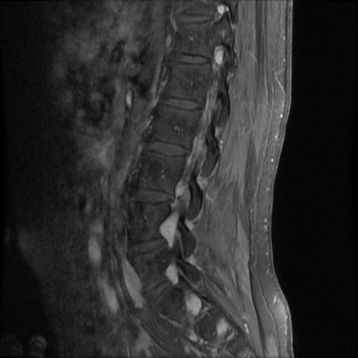File:Neurofibromatosis type 2 (spinal manifestations) (Radiopaedia 53943-60070 K 5).png