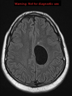File:Neuroglial cyst (Radiopaedia 10713-11184 Axial FLAIR 7).jpg
