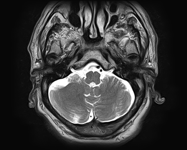 File:Non-Hodgkin lymphoma - parotid gland (Radiopaedia 71531-81890 Axial T2 21).jpg
