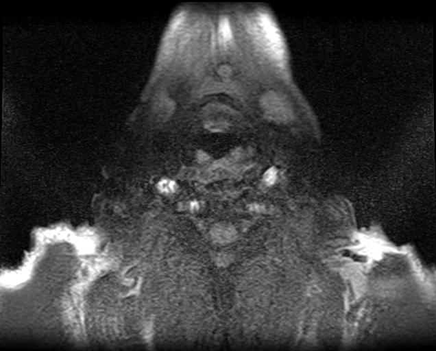 File:Non-Hodgkin lymphoma - parotid gland (Radiopaedia 71531-81890 T1 fat sat 2).jpg