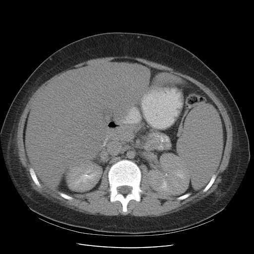 File:Non-Hodgkin lymphoma involving pelvis (Radiopaedia 21281-21197 B 28).jpg