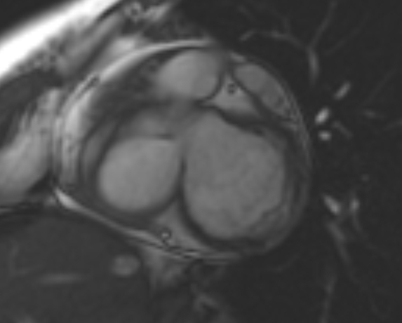 File:Non-compaction of the left ventricle (Radiopaedia 69436-79314 Short axis cine 193).jpg