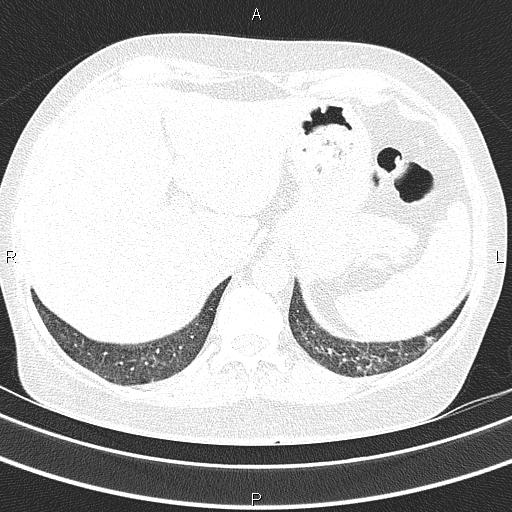 Non-specific interstitial pneumonia (Radiopaedia 83185-97567 Axial lung window 58).jpg