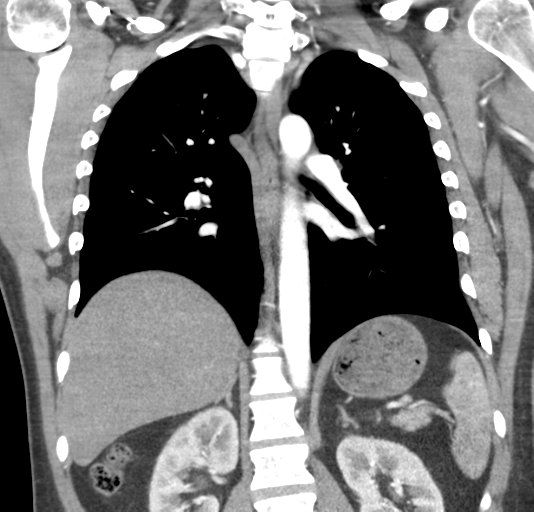 File:Normal CTA thorax (non ECG gated) (Radiopaedia 41750-44704 B 55).png