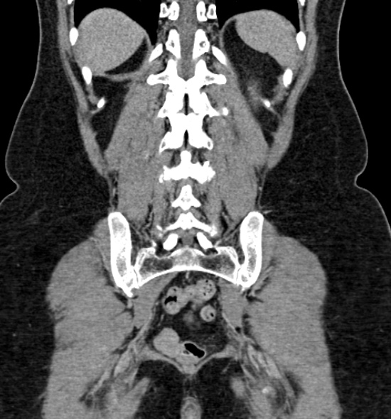 Normal CT intravenous urogram (Radiopaedia 39444-41759 A 347).jpg