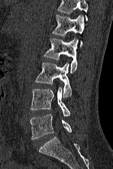 File:Normal CT lumbar spine (Radiopaedia 53981-60118 Sagittal bone window 39).jpg
