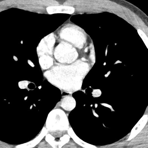 File:Normal CT pulmonary veins (pre RF ablation) (Radiopaedia 41748-44702 A 138).png
