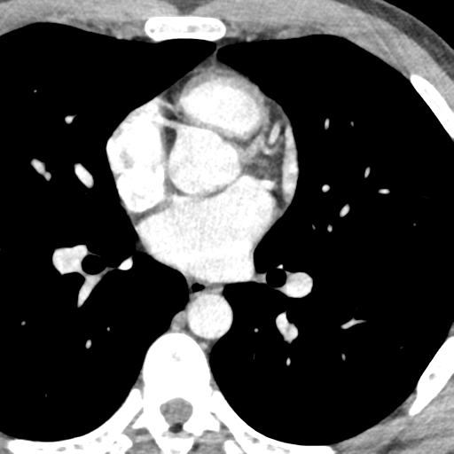 File:Normal CT pulmonary veins (pre RF ablation) (Radiopaedia 41748-44702 A 146).png