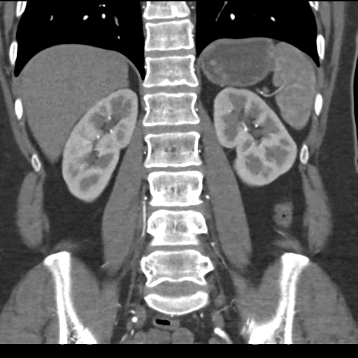 File:Normal CT renal artery angiogram (Radiopaedia 38727-40889 B 53).png