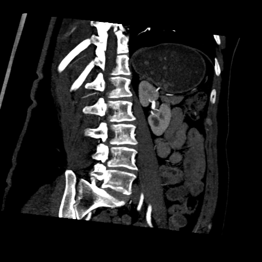 File:Normal CT renal artery angiogram (Radiopaedia 38727-40889 D 19).png