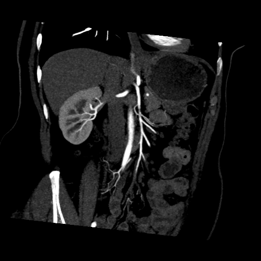 File:Normal CT renal artery angiogram (Radiopaedia 38727-40889 D 9).png